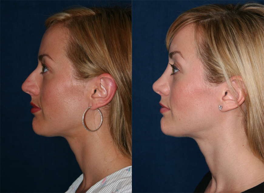 Rhinoplasty Rhinoplasty